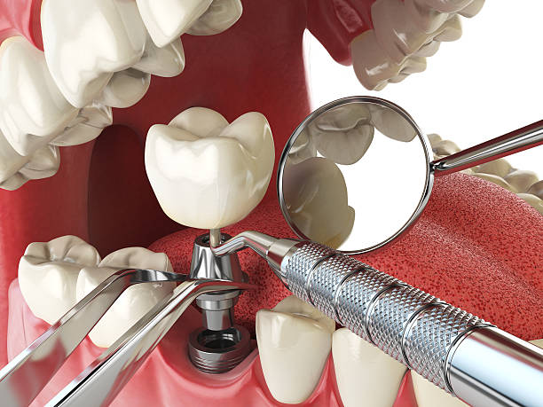 Best Knocked-Out Tooth Emergency  in Francisville, KY